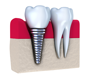 Cosmetic Dental Implants