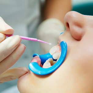 Dental Sealants Thumb