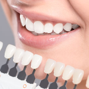 Teeth Whitening Charts Sq 300