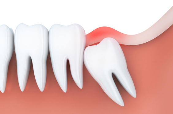 What Is Wisdom Teeth Removal