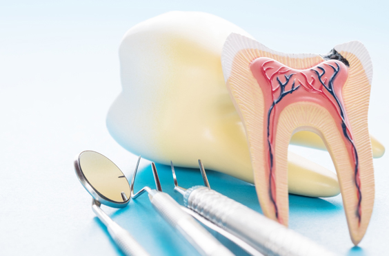 What Is A Root Canal