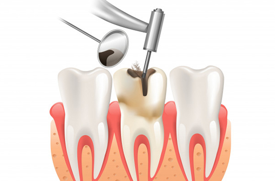 What Makes You A Viable Candidate For Root Canals