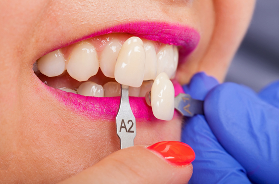 Who Is A Candidate For Porcelain Veneers