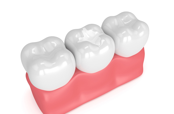 Who Is A Candidate For Sealants