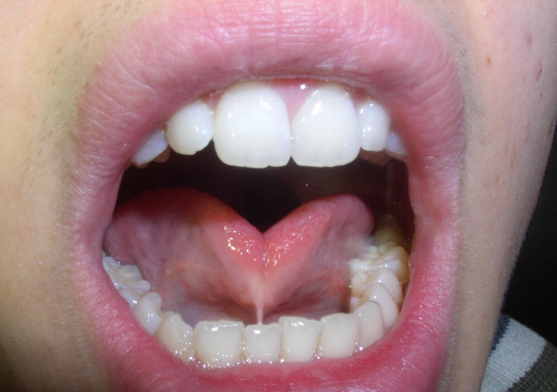 The Short Lingual Frenulum Problem