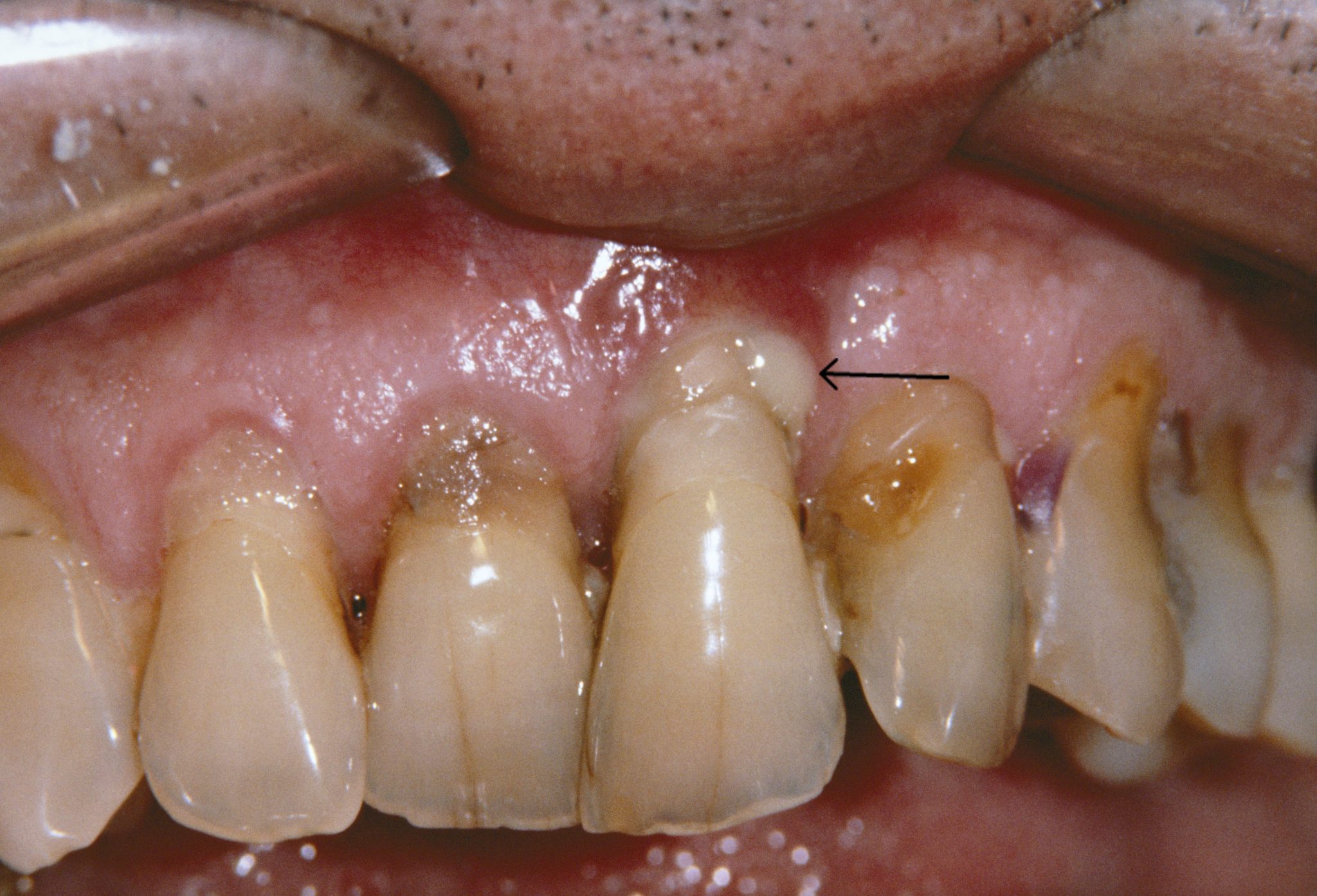 Periodontitis, What Is It