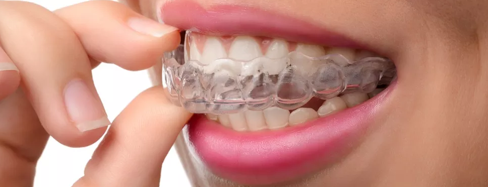 Bruxism, A Problem As Serious As It Sounds