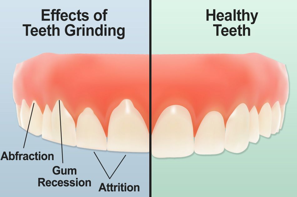 Teeth Or Clenching