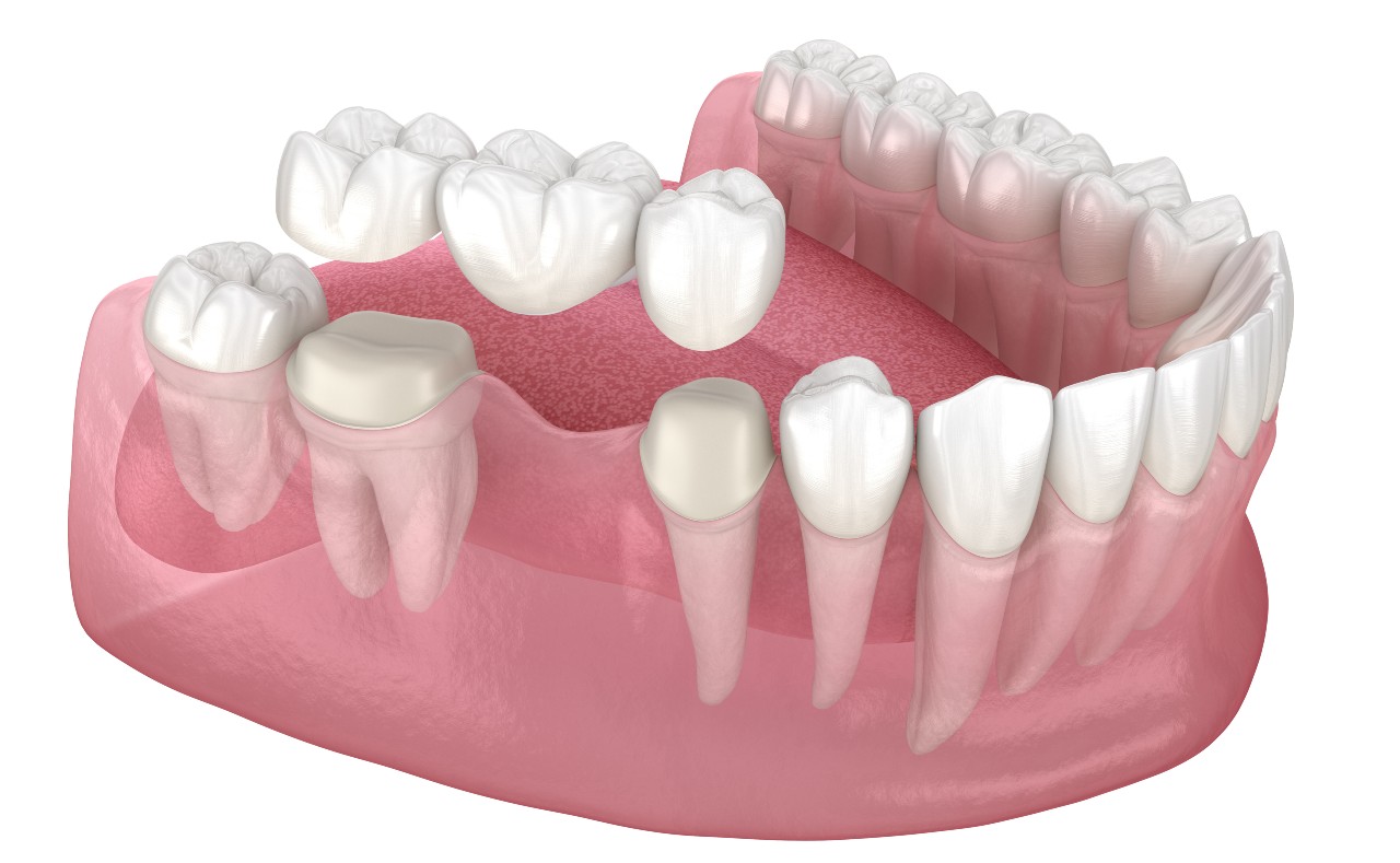 dental bridge