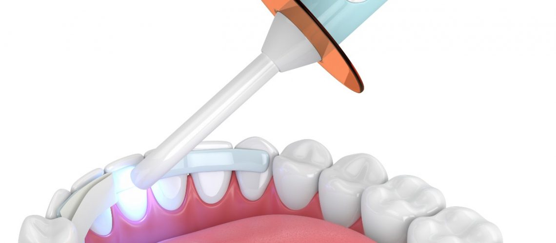 dental bonding