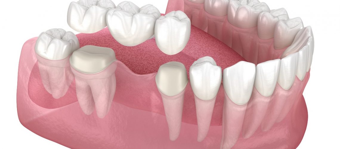 dental bridge