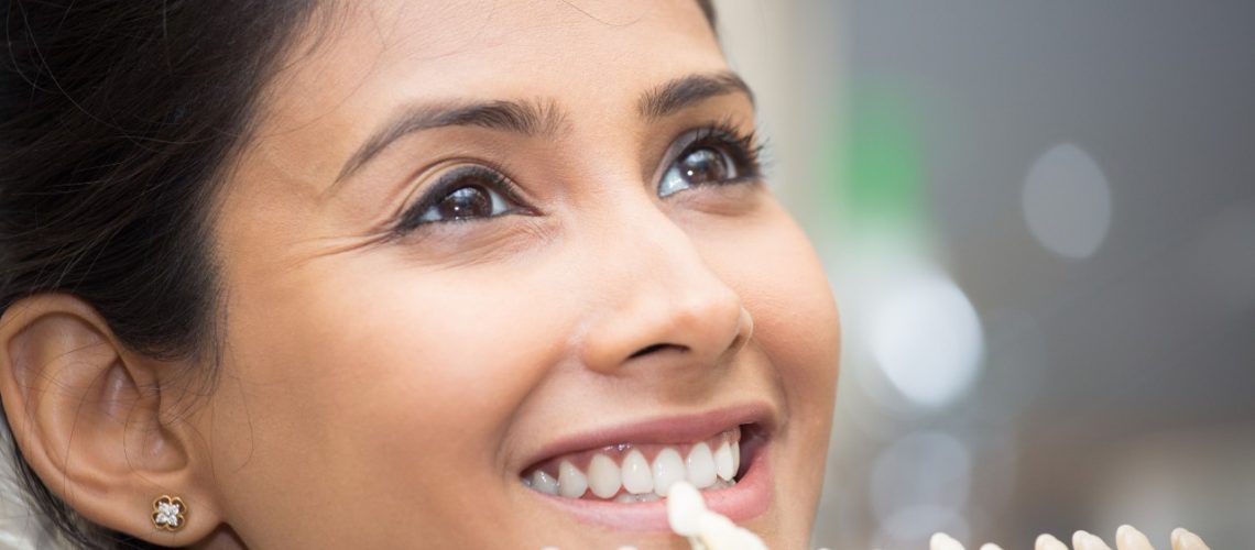 dental veneers