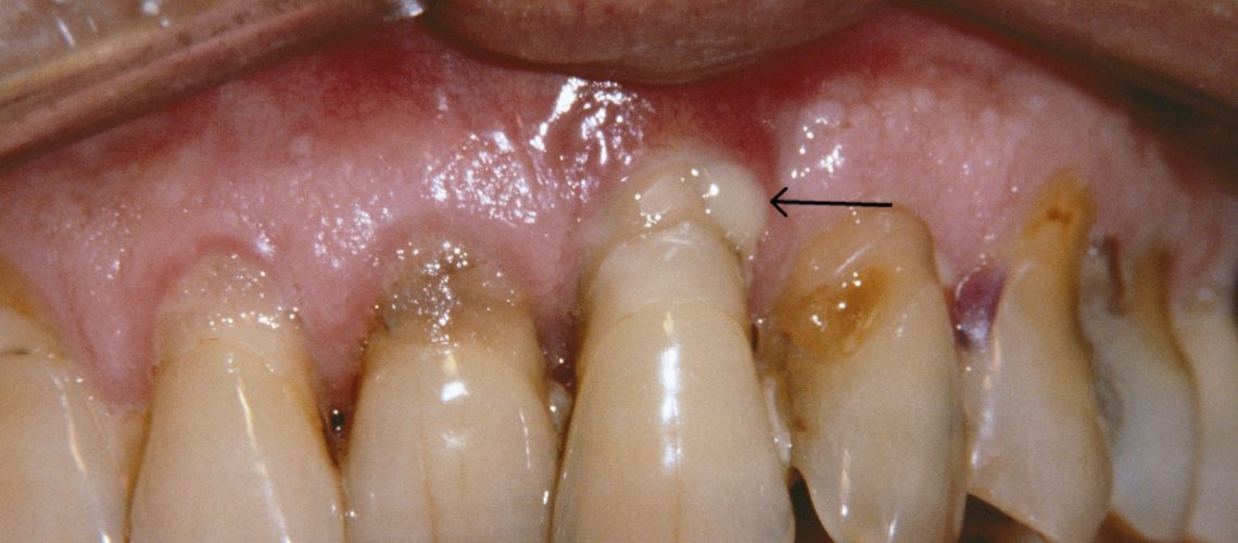 Periodontitis, What Is It