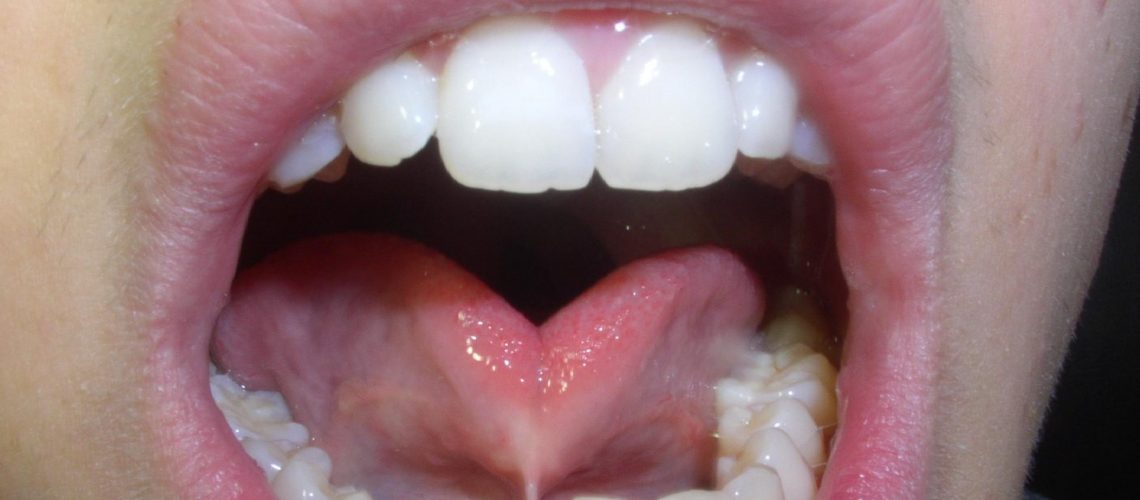 The Short Lingual Frenulum Problem Pierce Family Dentistry