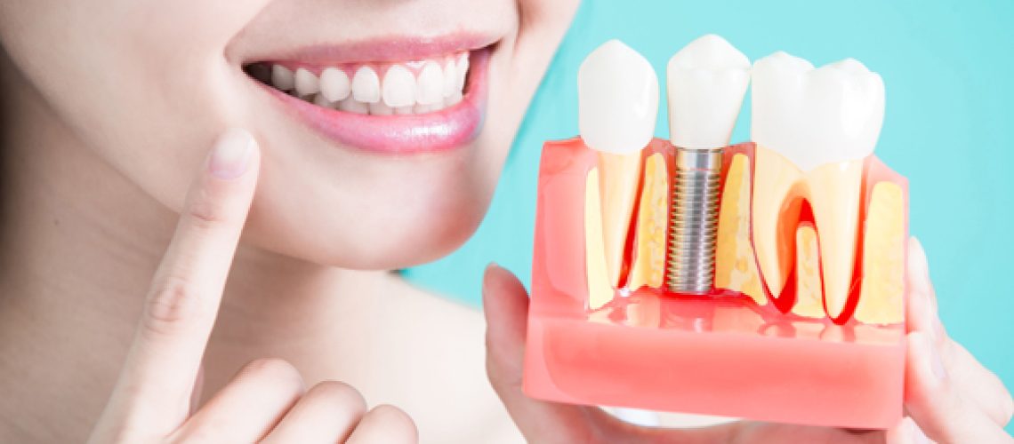 Who Is A Candidate For Dental Implants