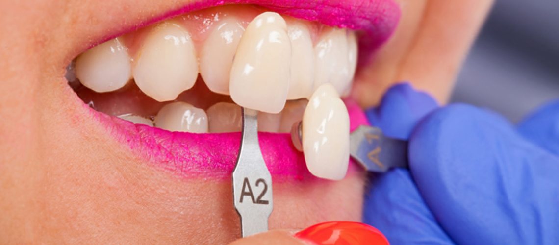 Who Is A Candidate For Porcelain Veneers